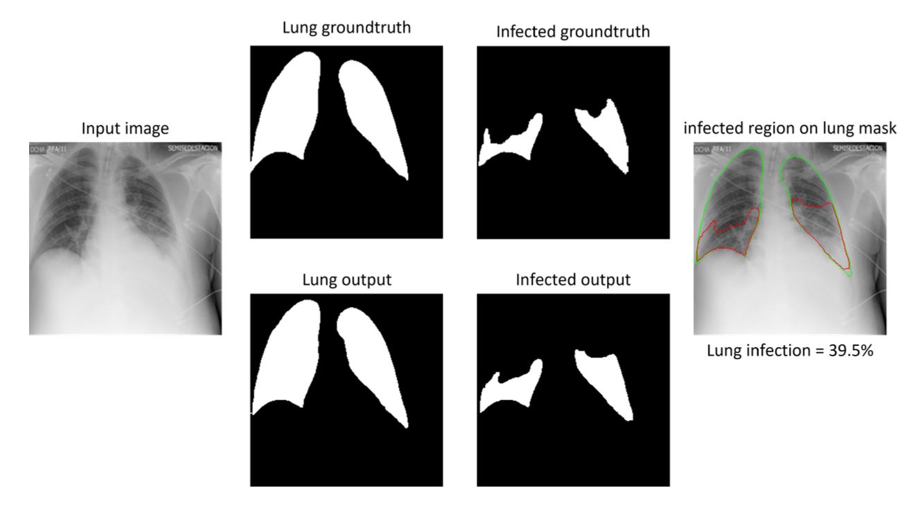 Delineating COVID-19 Pulmonary Infiltrate Manifestation Leveraging Auxiliary Tasks