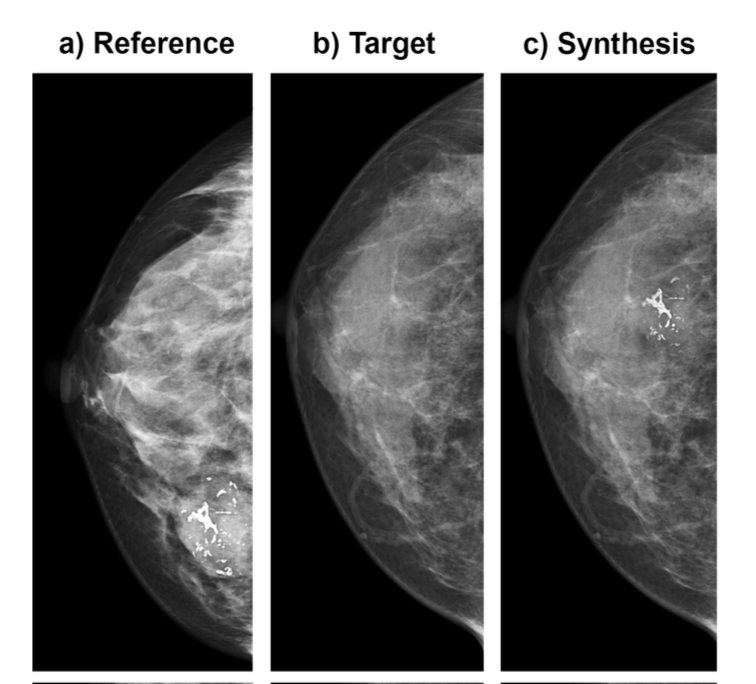 Towards Robust Natural-Looking Mammography Lesion Synthesis on Ipsilateral Dual-Views Breast Cancer Analysis